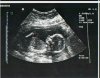 pregnancy-ultrasound-17-weeks.jpeg